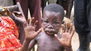 monkeypox-virus