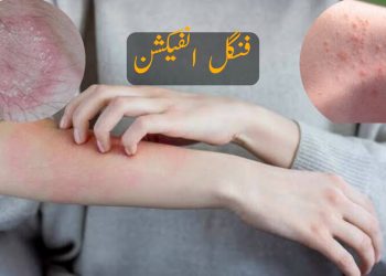 کراچی :شدید گرمی کے باعث جلدکے امراض بڑھنے لگے