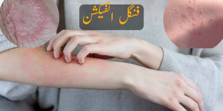 کراچی :شدید گرمی کے باعث جلدکے امراض بڑھنے لگے