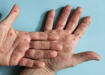 منکی پوکس نے 7 ماہ میں 548 جانیں نگل لیں