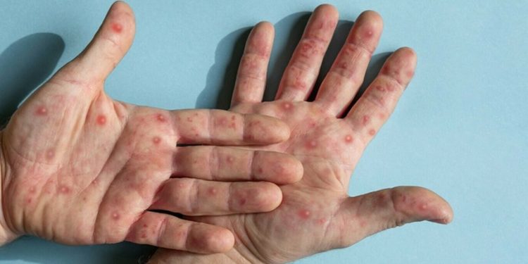 منکی پوکس نے 7 ماہ میں 548 جانیں نگل لیں