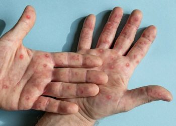 پاکستان میں منکی پاکس کی وبا قابو میں ہے:وزارت قومی صحت