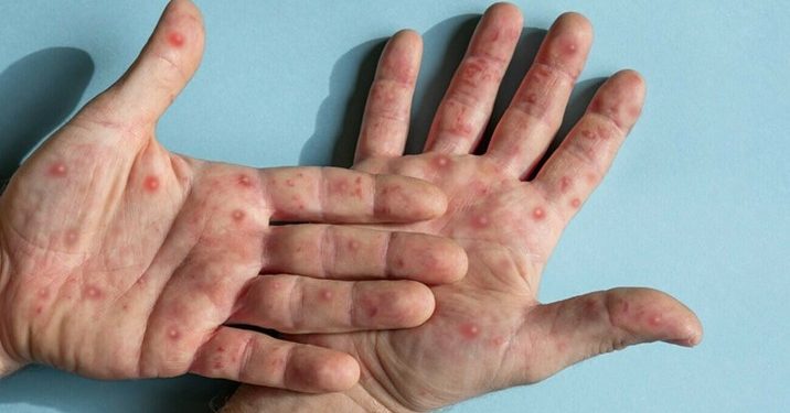 پاکستان میں منکی پاکس کی وبا قابو میں ہے:وزارت قومی صحت