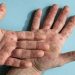 پاکستان میں منکی پاکس کی وبا قابو میں ہے:وزارت قومی صحت