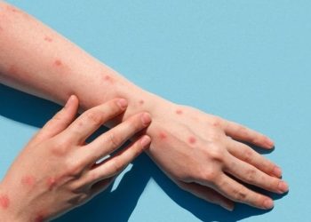 پاکستان میں منکی پاکس کے کیسز پر ایڈوائزری کا اعلان