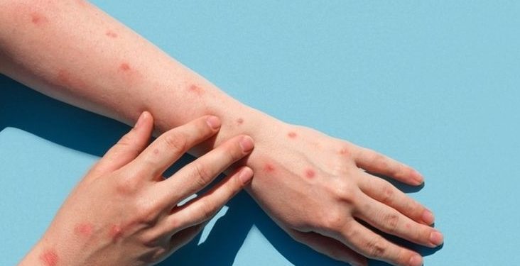 پاکستان میں منکی پاکس کے کیسز پر ایڈوائزری کا اعلان
