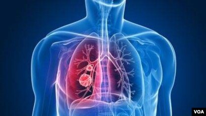 کبھی تمباکو نوشی نہ کرنے والوں میں پھیپھڑوں کے کینسر کا خطرہ، نئی تحقیق