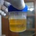 پیشاب میں کیڈمیئم کی زائد مقدار سے دماغی صحت کو شدید خطرہ: تحقیق