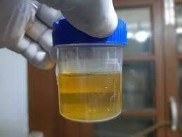 پیشاب میں کیڈمیئم کی زائد مقدار سے دماغی صحت کو شدید خطرہ: تحقیق