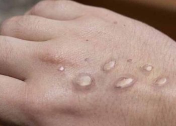 پاکستان میں نئے سال کا پہلا منکی پاکس کیس رپورٹ