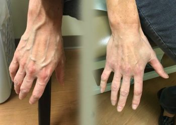 کچھ لوگوں کے ہاتھوں کی رگیں بہت زیادہ ابھری ہوئی کیوں ہوتی ہیں؟